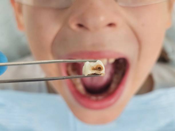 Best Knocked-Out Tooth Emergency  in Desnso, CA